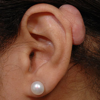keloid jizva piercing